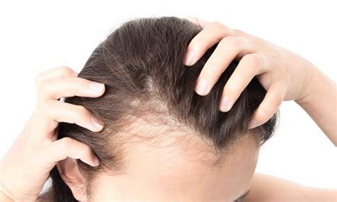 Other types of alopecia are alopecia totalis and alopecia universalis. Hair Loss and Hormonal Imbalance in Women | BeautyOnFleeck