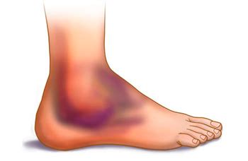 What do your symptoms mean? Ankle Sprain. Symptoms, Causes and Treatment of Ankle Sprain