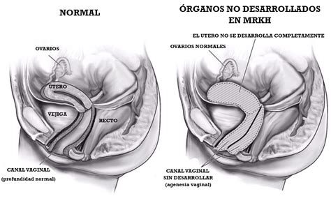 Da keine gebärmutter vorhanden ist, kann die. Síndrome de Mayer - Rokitansky - Küster - Hauser tipo 2 ...