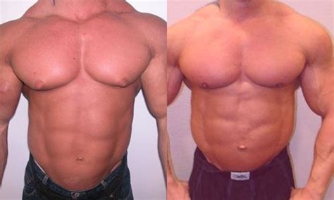 How to prevent ingrown hairs. before and after gynecomastia surgery. Bodybuilding ...