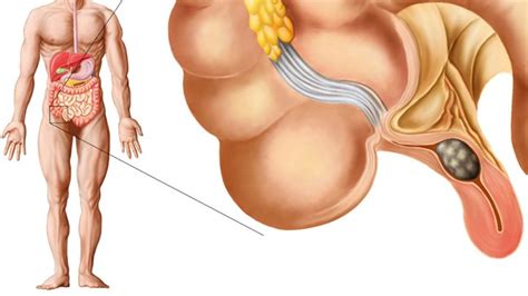 Abdominal pain is the most common symptom of acute appendicitis. What Causes Appendicitis? | Everyday Health