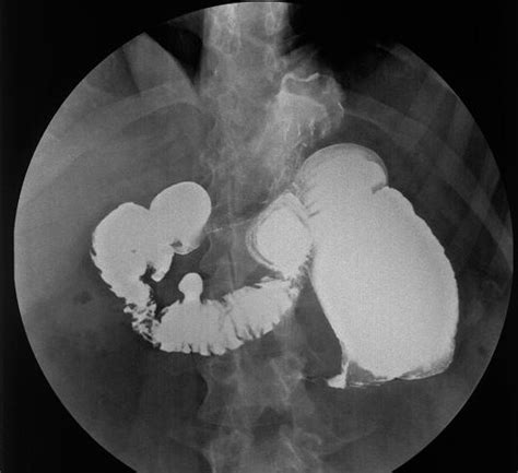 Other specified intestinal obstruction of newborn. Small Intestinal Stricture Complicating an Asymptomatic ...