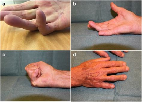 A new finger-preserving procedure as an alternative to amputation in ...