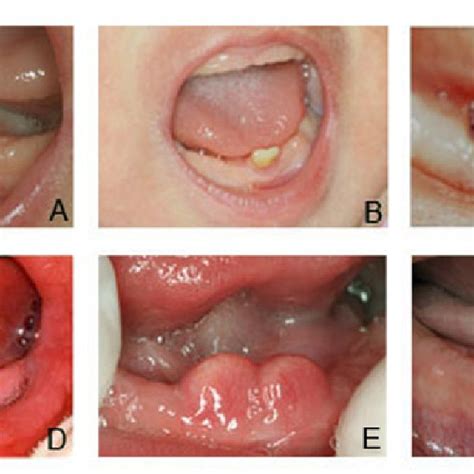 They have little root structure. (PDF) Natal and Neonatal Teeth: A Review of 23 Cases
