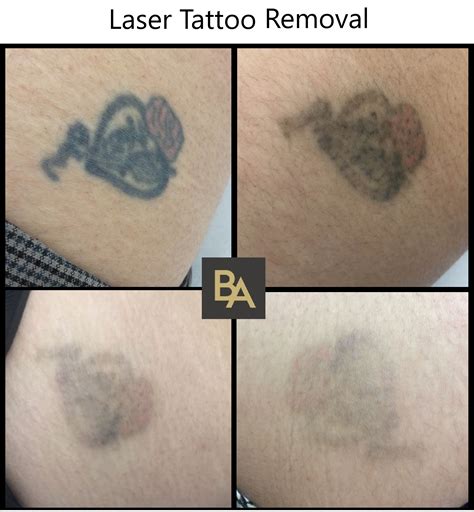 Laser tattoo removal may not be suitable for you if you have a dark skin tone; LASER ⚡️ TATTOO REMOVAL . Amazing results after just 4 Treatments!! 😍 . To find out more or to ...