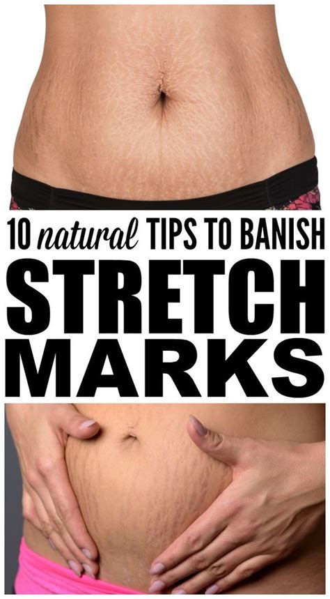 Are red, purple, silver, white. Streaks and Stripes: 13 Natural Remedies for Stretch Marks ...