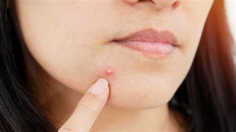 Folliculitis is typically an infection that does not require any in most cases, these lumps are harmless cysts, but they may develop into testis cancer. Skin purging: What does skin purging look like? | mamabella