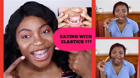 Orthodontic treatment with braces can bring a lot of changes in your smile and overall health. Can You Eat Food With Elastics On Your Braces? - YouTube