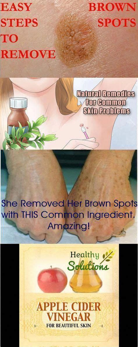 How to get Rid Of Brown Spots on Experience # ...