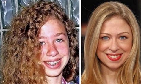 Chelsea Clinton Plastic Surgery Makeover: Before & After ...