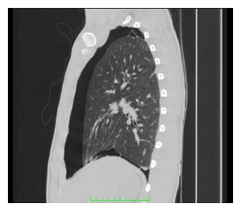 Ct scans have various purposes. Automated Quantification of Pneumothorax in CT