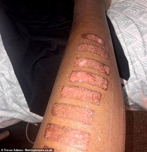 Melanin is the dark pigment in your hair. Graduate, 22, scarred for life by laser hair removal ...