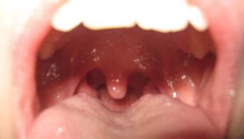 Los dos casos de mucormicosis pulmonar notificados por fürbringer en 1876 fueron los primeros descritos. Organi e Tessuti dell'Endoderma - Attivazioni Biologiche