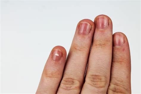 Our nails work as ideal indicators of health. Red Lines On Fingernails - Causes, Prevention & Treatment