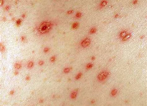 A rash is a symptom of hiv that usually occurs within the first two months after becoming infected with the virus. HIV Rash Pictures, Images, Symptoms, Treatment