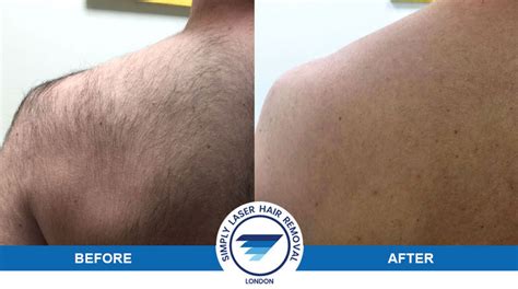 The complete laser hair removal process requires a series of treatments, but results can start to be seen after the first treatment. Laser Hair Removal for Men