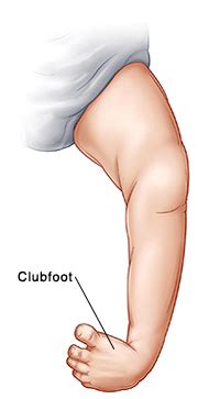 Screening for club foot prenatally is a debatable topic. When Your Child Has Clubfoot