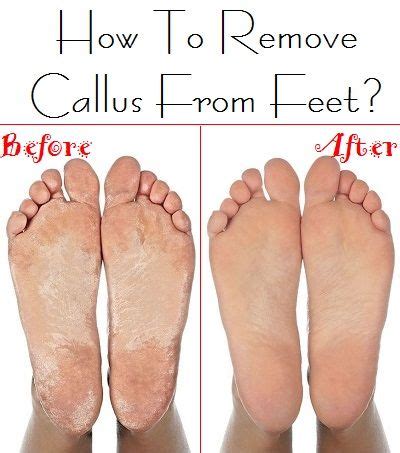 Soaking your feet in warm water for at least ten minutes, and using thick moisturizers and lotions once the skin is dry can help soften the callus. How To Remove Callus From Feet? | Callus removal, Foot ...