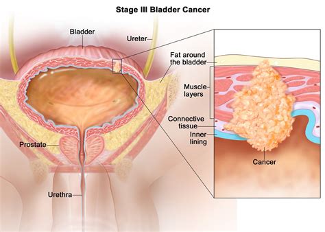Symptoms include blood in the urine, pain with urination, and low back pain. Bladder Cancer - Causes, Symptoms, Signs, Diagnosis ...