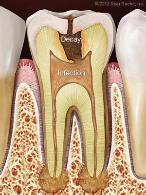 The treatment of bone infection depends on the extent of the infection. Root Canal Treatment | Hot Springs National Park Dental ...