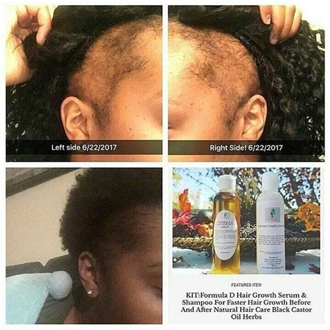 Over 48,000 clients worldwide are experiencing complete restoration from hair loss from medication, illness and ccca and the big chop. Formula D Extra Strength 3 Piece Kit Hair Restoration For ...