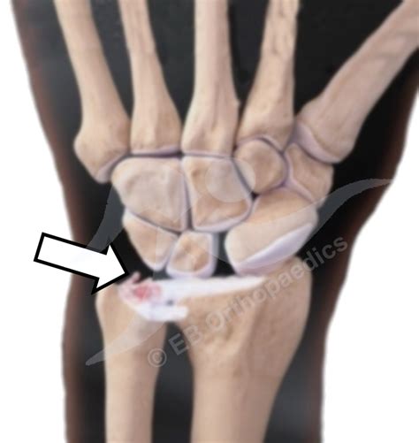 The wrist is actually a collection of many bones the triangular fibrocartilage complex (tfcc) suspends the ends of the radius and ulna bones over the wrist. Orthopaedic & Trauma Surgeon - Wrist - TFCC injury