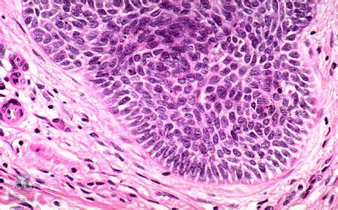 We did not find results for: Skin Under the Microscope: Basal Cell Carcinoma of skin ...