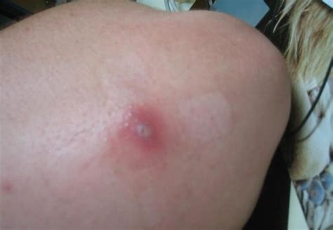 Many bites will clear up within a few hours or days and can be safely treated at home. pictures of brown recluse spider bites | http ...