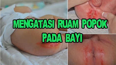 Penyakit infeksi telinga pada bayi termasuk penyakit umum. Cara Mengatasi Ruam Popok Pada Bayi #VLOG 3 - YouTube