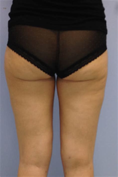 La lipoaspiration du ventre doit être couplée à la lipoaspiration des poignées d'amour quand elles sont. Liposuccion à Villefranche et Lyon : chirurgie esthétique