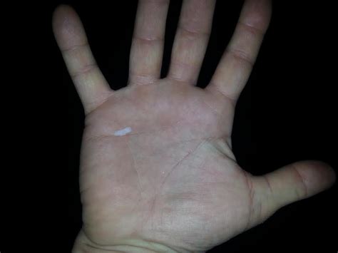 I'm a typical stubborn man and i've tried to fix it myself by digging it out with a small knife or needle, freezing it off with dry ice (when i thought it may be a wart), and i've tried to cauterize the wound with a. Tips for Avoiding Blisters and Developing Healthy Calluses ...