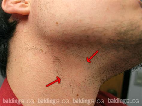 There is usually no scaling or redness, but bald areas appear either on the scalp or in the beard area. I Have Very Patchy Facial Hair (with Photo) | WRassman,M.D ...