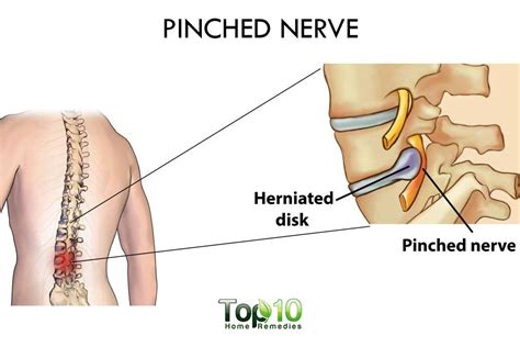 It provides the visual representation of all the possible causes for a problem to analyze and find out the root cause. Home Remedies for a Pinched Nerve | Top 10 Home Remedies