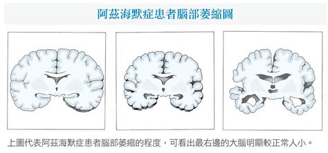 For faster navigation, this iframe is preloading the wikiwand page for 阿茲海默症. 失智就是「阿茲海默症」？一張表看清楚各類失智症 | 閱讀，對身體好! | 健康遠見 - 對身體好!