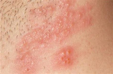 Eczema, or dermatitis as it is otherwise known, simply means inflammation of the skin. Le zona - NotreFamille.com