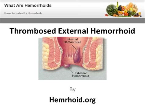 Has anyone had an experience like this? Thrombosed External Hemorrhoid