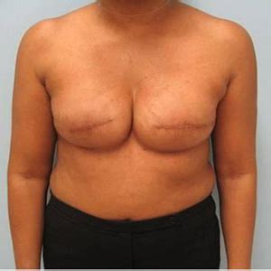 Doctors may also recommend hormone therapy, as well as. Patient 4 Breast Reconstruction | Newman Plastic Surgery