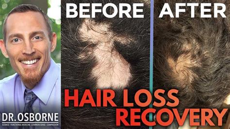 You may have heard about yes, depending on what's causing your hair loss, you may be able to grow some of it back. Can hair loss be reversed naturally - YouTube