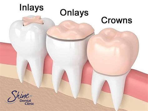 Maybe you would like to learn more about one of these? The Differences Between Crowns, Onlays, Inlays, Veneers ...