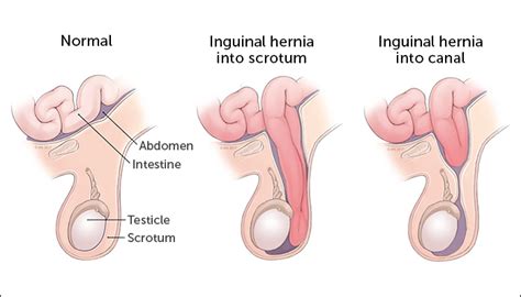 Anda bisa mencoba pilihan obat masuk angin atau cara alami ini untuk redakan ibuprofen juga bisa diminum oleh ibu hamil, ibu menyusui, dan bayi asal disesuaikan dengan resep yang diberikan dokter. 'Angin Pasang' (Hernia) Pada Bayi Tak Boleh Diurut ...