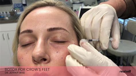 How many botox injections do you get for migraine? Botox injections to get rid of crow's feet - YouTube