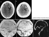 The delta symbol comes in two ways one is filled delta, and another one is empty delta. Abbildungen und Graphiken: Sinus- und Hirnvenenthrombose