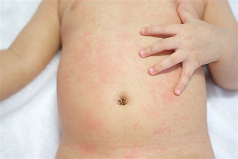 It is common for breastfed babies to have minor rashes around the neck region. Roseola In Toddlers: Causes, Symptoms And Treatment