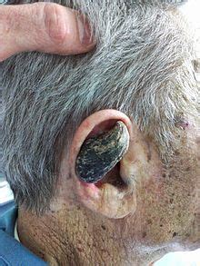 Nsfl material is not allowed. Cutaneous horn - Wikipedia
