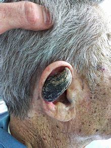 Cutaneous horns, also known by the latin name cornu cutaneum, are unusual keratinous skin tumors with the appearance of horns, or sometimes of wood or coral. Cutaneous horn - Wikipedia