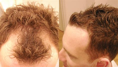 How to stop a hair loss? Receding Hairline | International Hair Studio