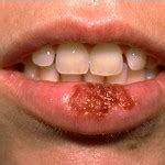 Since herpes prefers the path of least resistance, it does most often appear in the same spot. Oral herpes Part 1 | Intelligent Dental