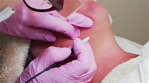 Generally, laser hair removal works on darker hair and can be safely used light to medium skin tones. Electrolysis Permanent Hair Removal - YouTube