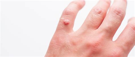 VERRUCHE | Alloi Cagalli Presta - Studio Dermatologico a ...