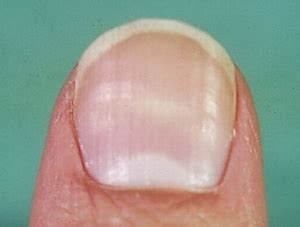 ■爪カンジダ症 症状としては爪白癬とほぼ同じ。 診断は培養でカンジタを検出すること。 治療は抗真菌薬の内服。 爪カンジダ 縦の線が入り先端が割れています. 病気 爪 でこぼこ - Hello Doctor